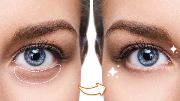 Say Goodbye To Dark Circles And Puffy Eyes!